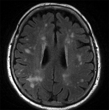 White matter lesions
